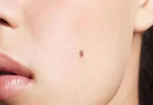 Tahi Lalat: Penyebab, Risiko, dan Perhatian