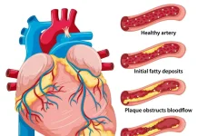 Arteri Tersumbat: Penyebab, Gejala, dan Pengobatan