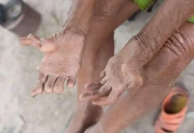 WHO: Penanganan Kusta Harus Dilakukan Secara Kolektif