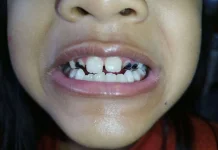 Ketahui Penyebab Karies Gigi Pada Anak Serta Penanganannya