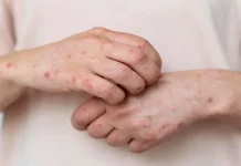 Waspada Ruam Kulit, Kenali Gejala Kusta Sejak Dini