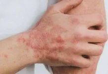 Deteksi Dini Kunci Cegah Kecacatan Akibat Kusta